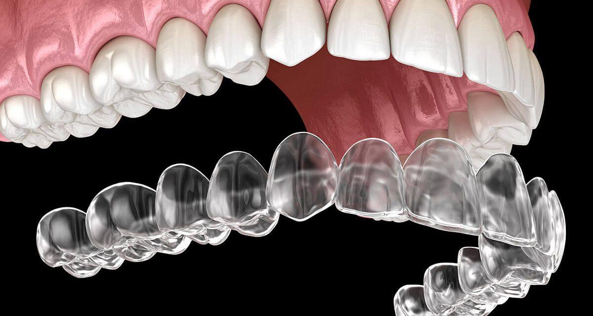 Aligner (Láthatatlan fogszabályozó)